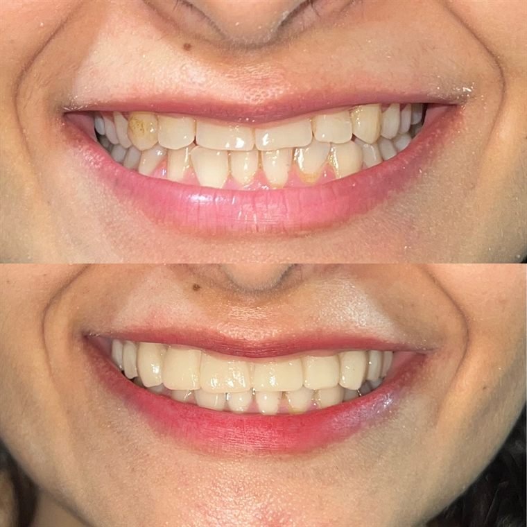 Treatment result at Delhi Dental Cosmetics
