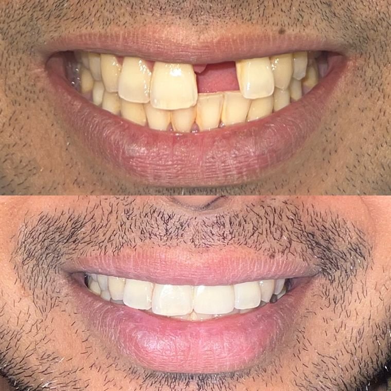 Treatment result at Delhi Dental Cosmetics