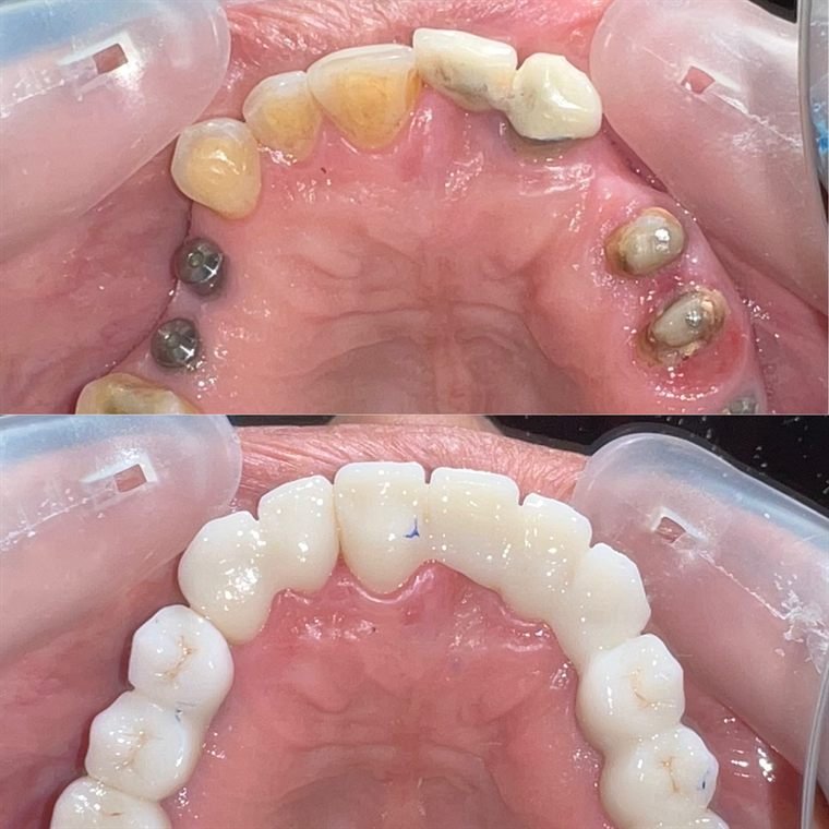Treatment result at Delhi Dental Cosmetics