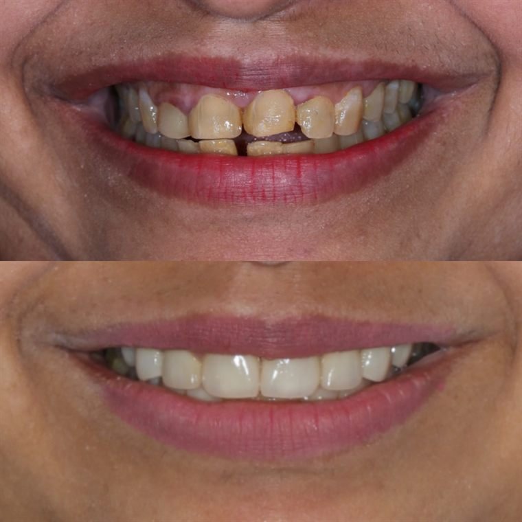 Treatment result at Delhi Dental Cosmetics