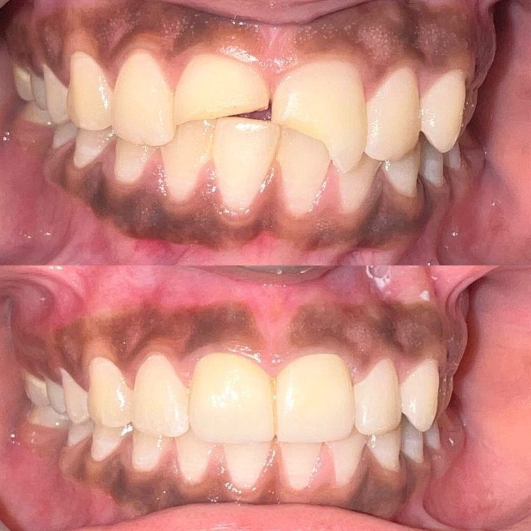 Treatment result at Delhi Dental Cosmetics