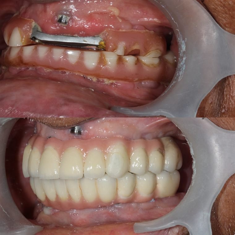 Treatment result at Delhi Dental Cosmetics