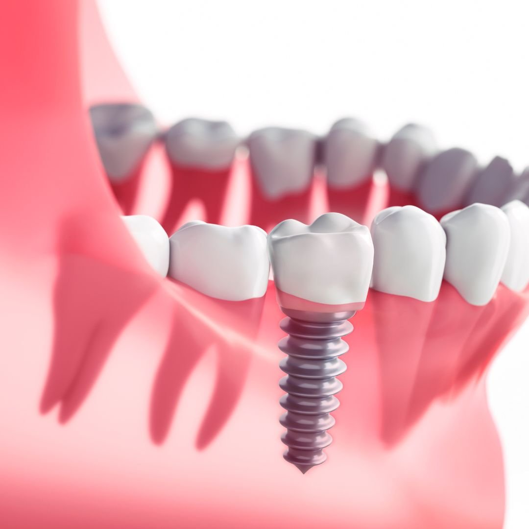 Multiple implants