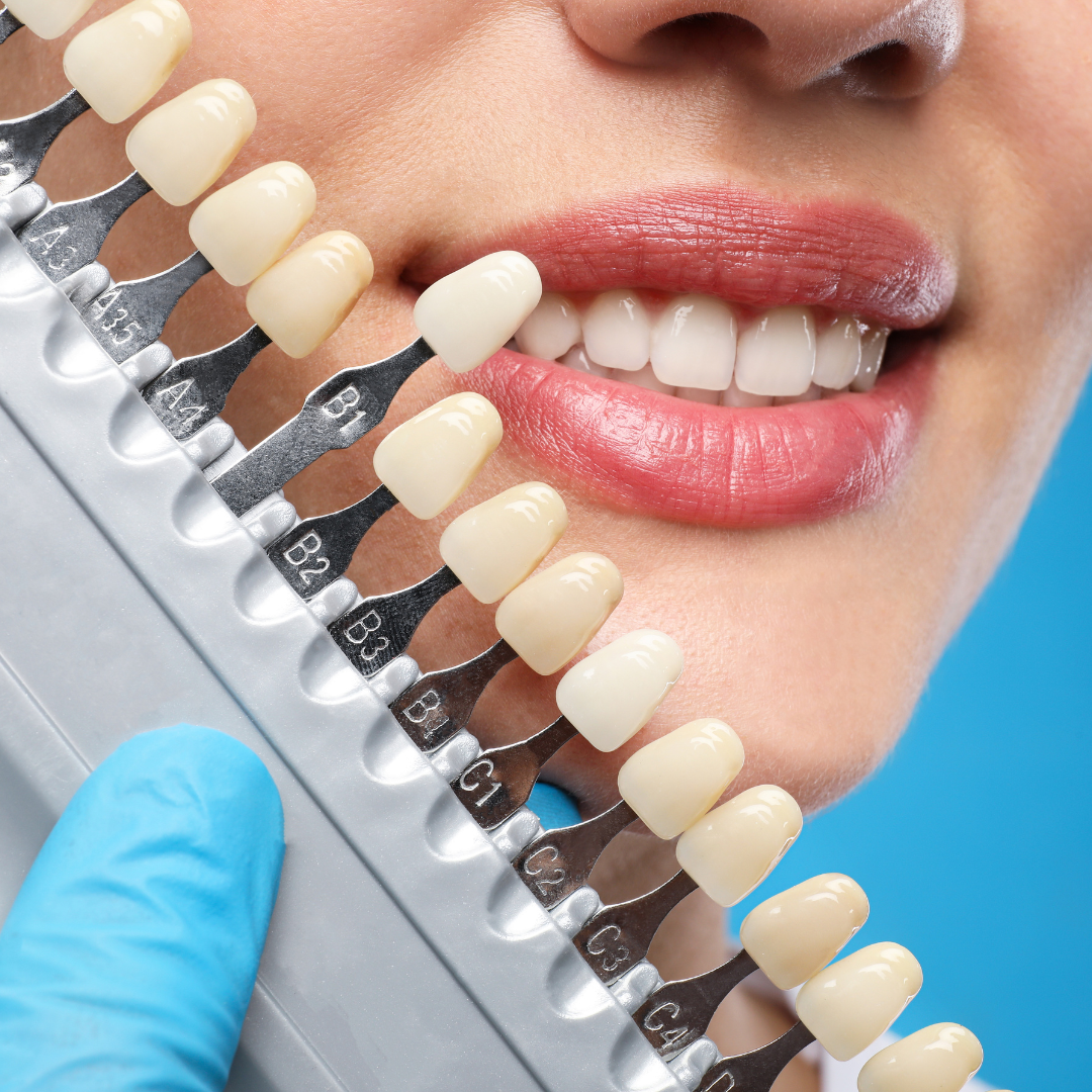 Teeth whitening