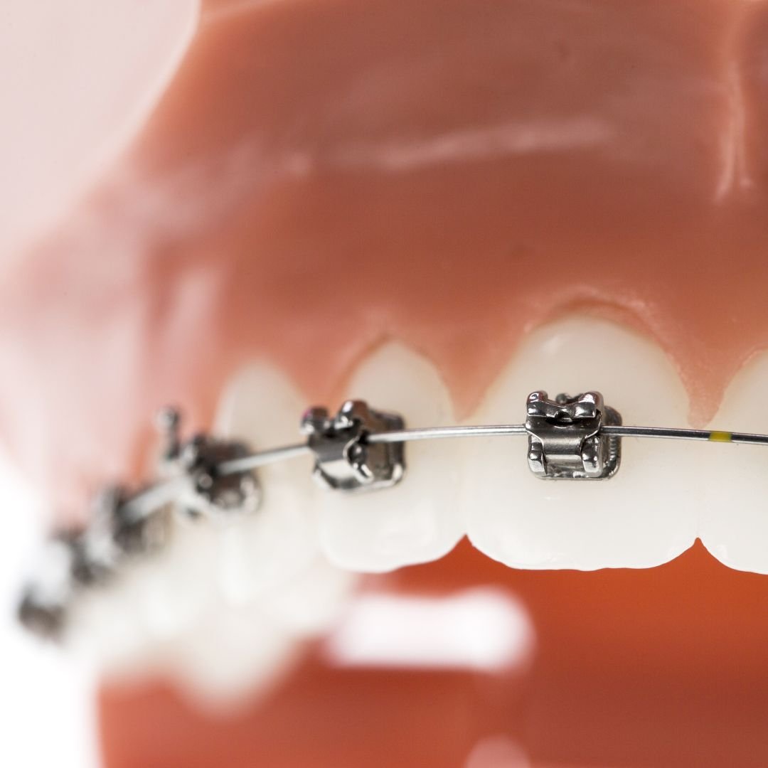 Invisalign clear aligners