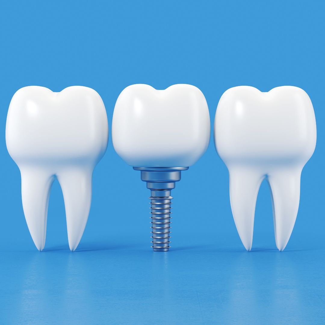 Single tooth implants