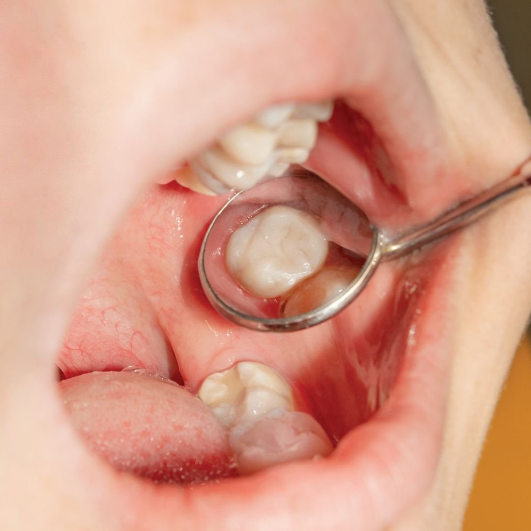 Tooth-coloured fillings