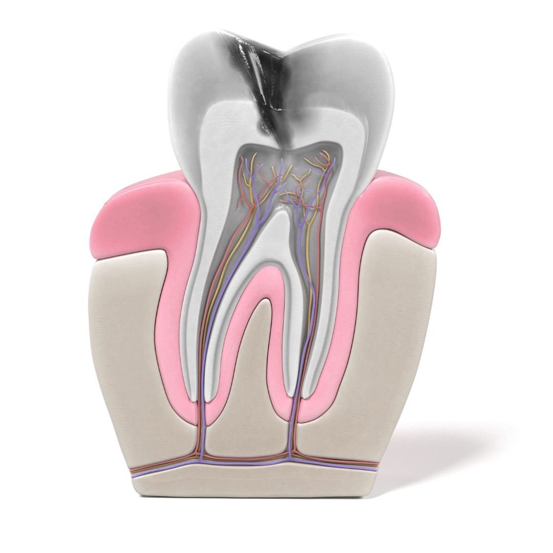 Endodontic surgery (apicoectomy)