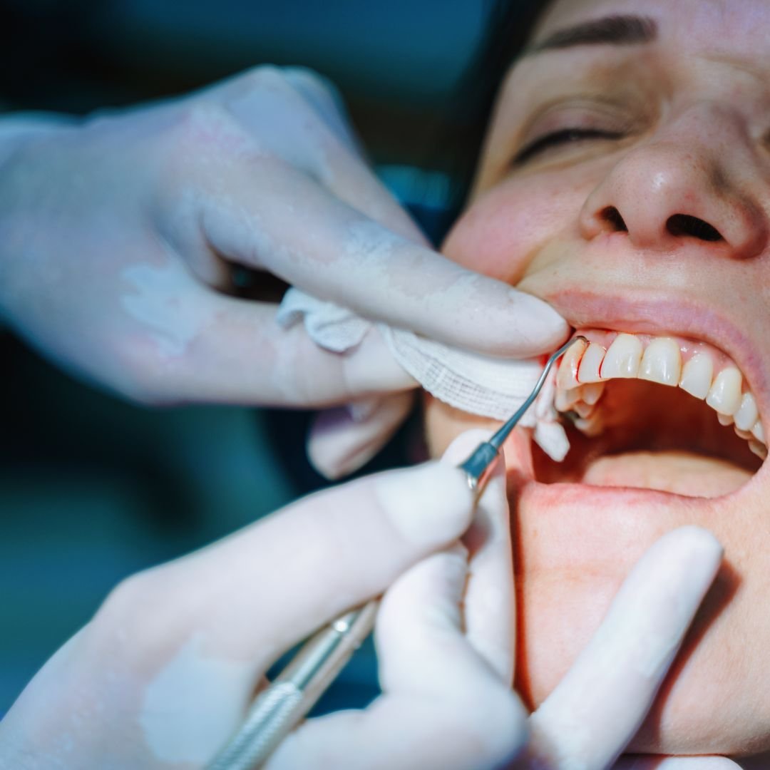 Oral surgery at Delhi Dental Cosmetics