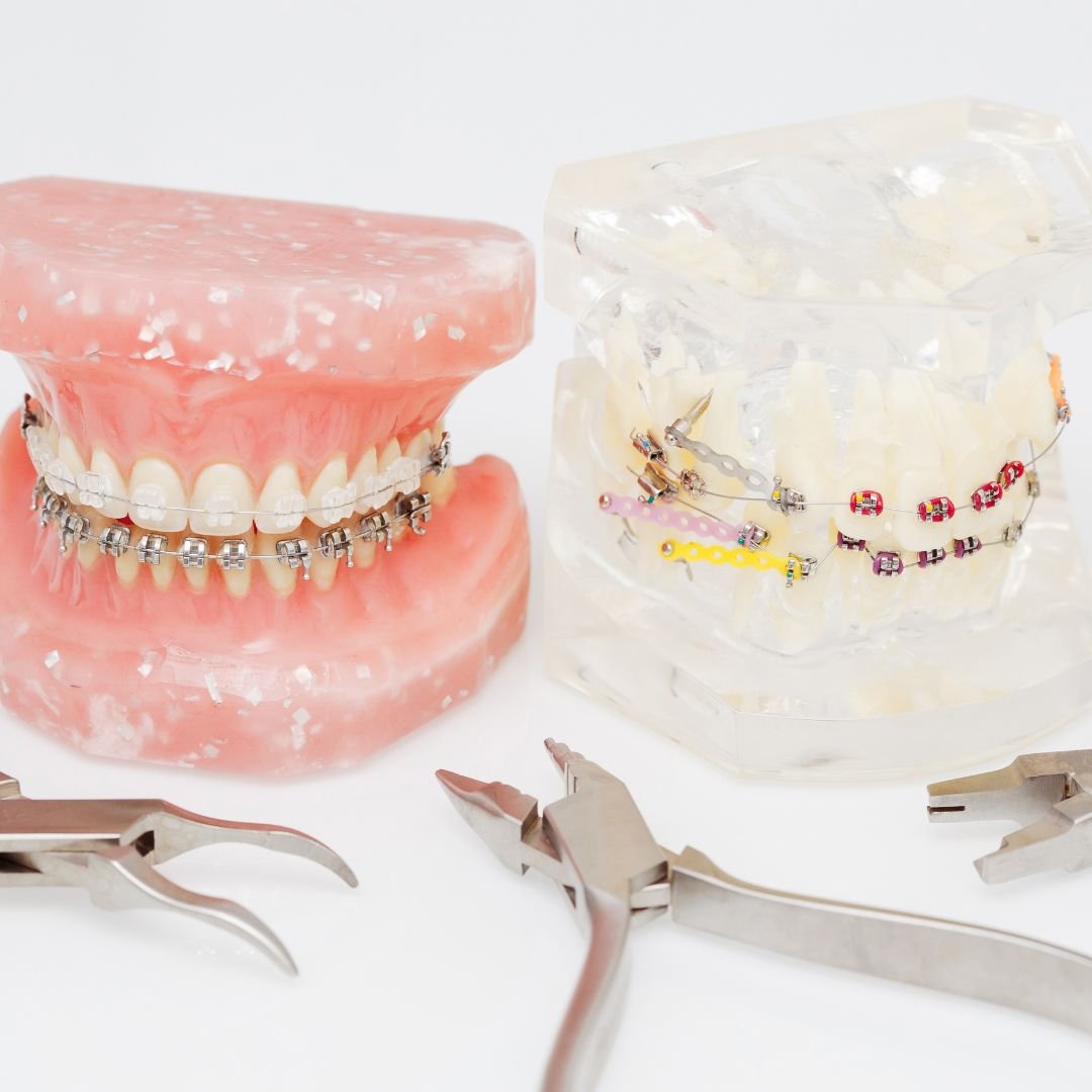 Traditional braces