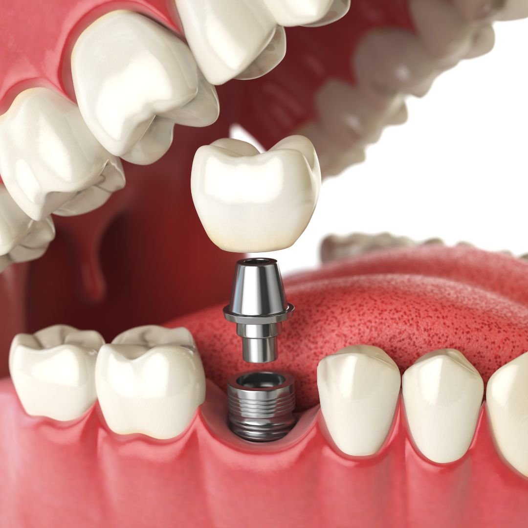Full arch implants